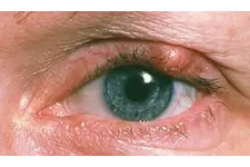 Gözde Kılcal Damar Çatlaması Belirtileri ve Tedavisi