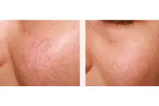 Kılcal Damar Genişlemesi Belirtileri ve Tedavisi