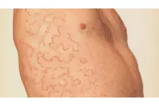 Memede Kılcal Damar Belirtileri ve Tedavisi