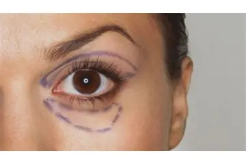 Göz Altı Kılcal Damar Çatlaması Belirtileri ve Tedavisi