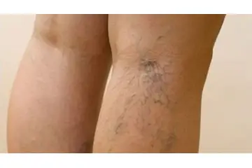 Kılcal Damar Çatlaması Belirtileri ve Tedavisi