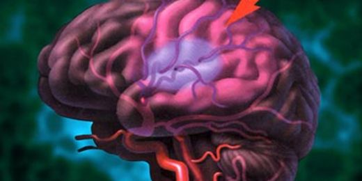 Beyinde Kılcal Damar Çatlaması Belirtileri ve Tedavisi
