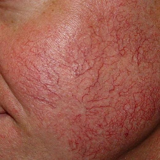 Yüzdeki Kılcal Damarlar Özellikleri ve Faydaları Nelerdir?